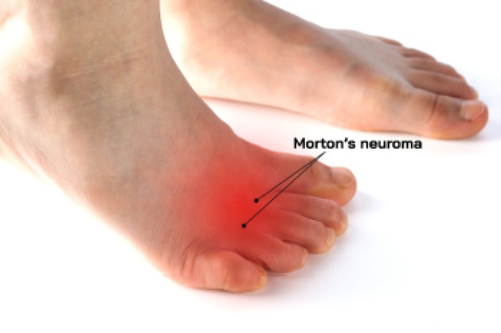 Symptoms of Morton’s Neuroma