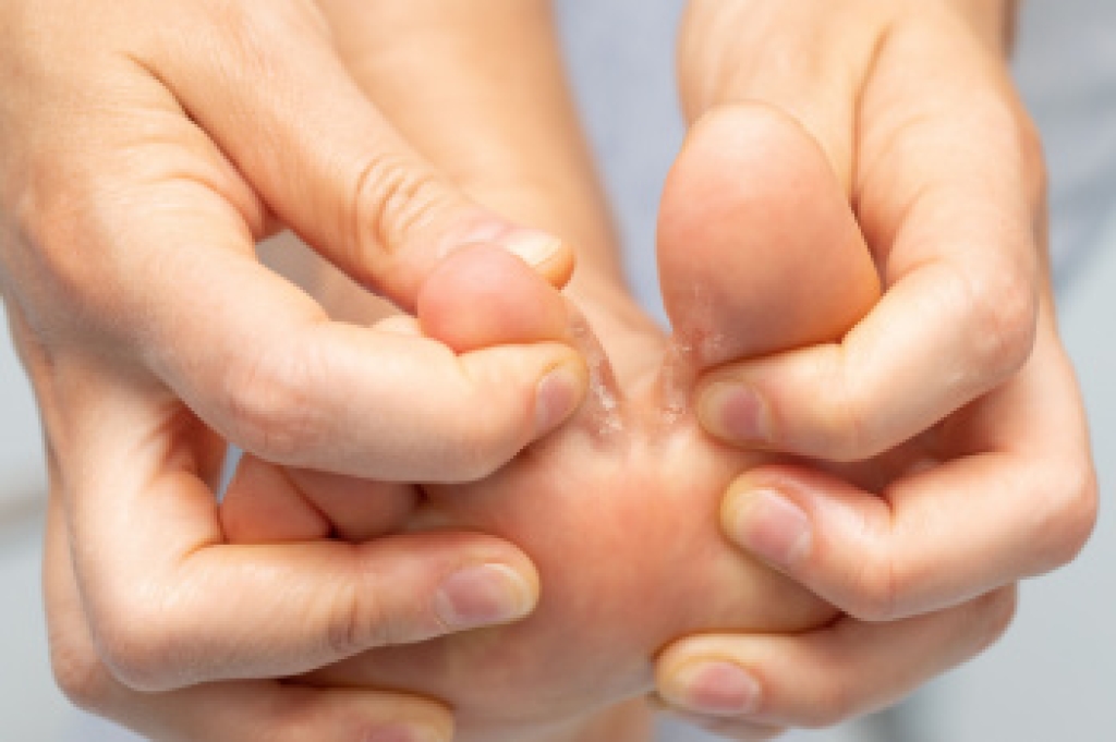 How Athlete's Foot Is Evaluated