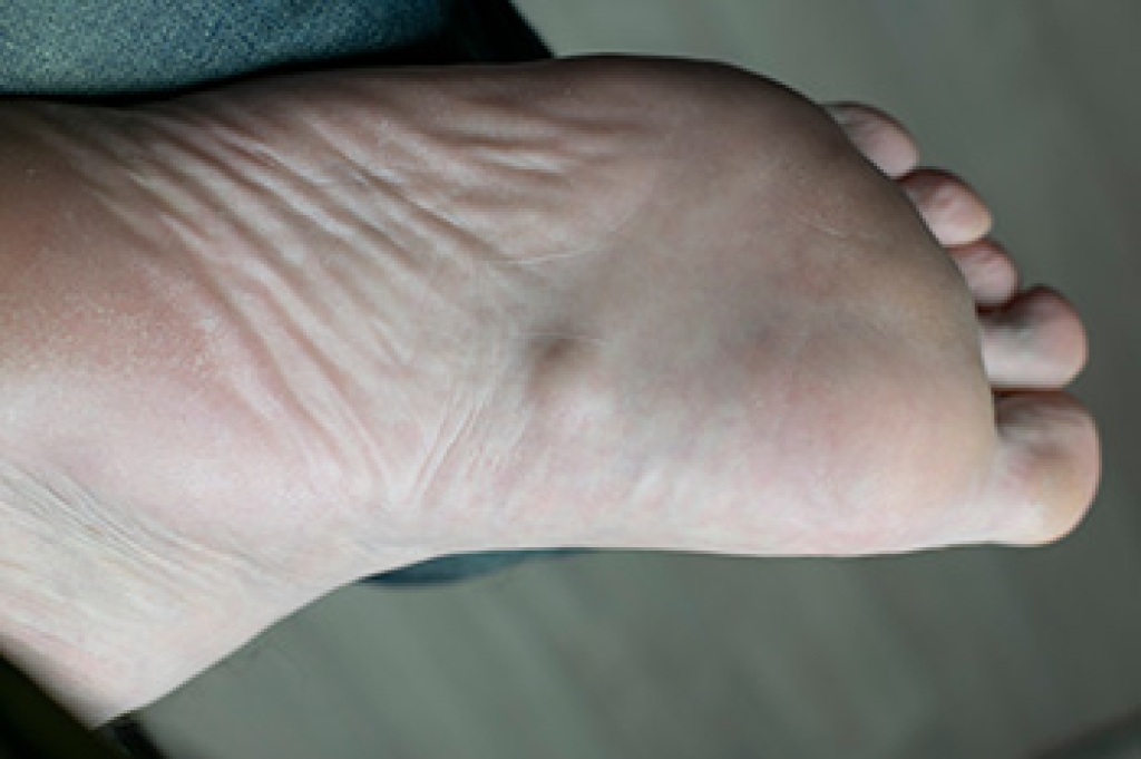 What Is a Plantar Fibroma?