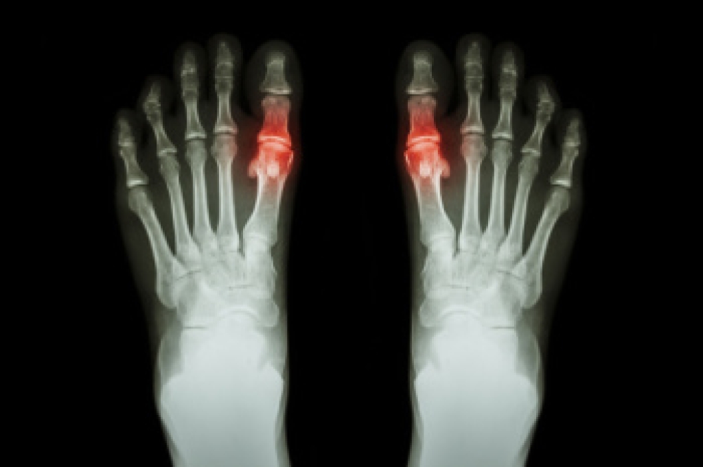 Gout Can Lead to Lasting Bone and Joint Damage
