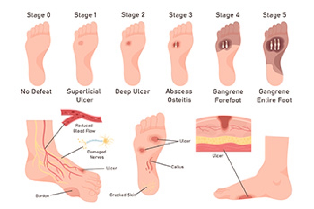 Preventing Setbacks from Diabetic Foot Ulcers