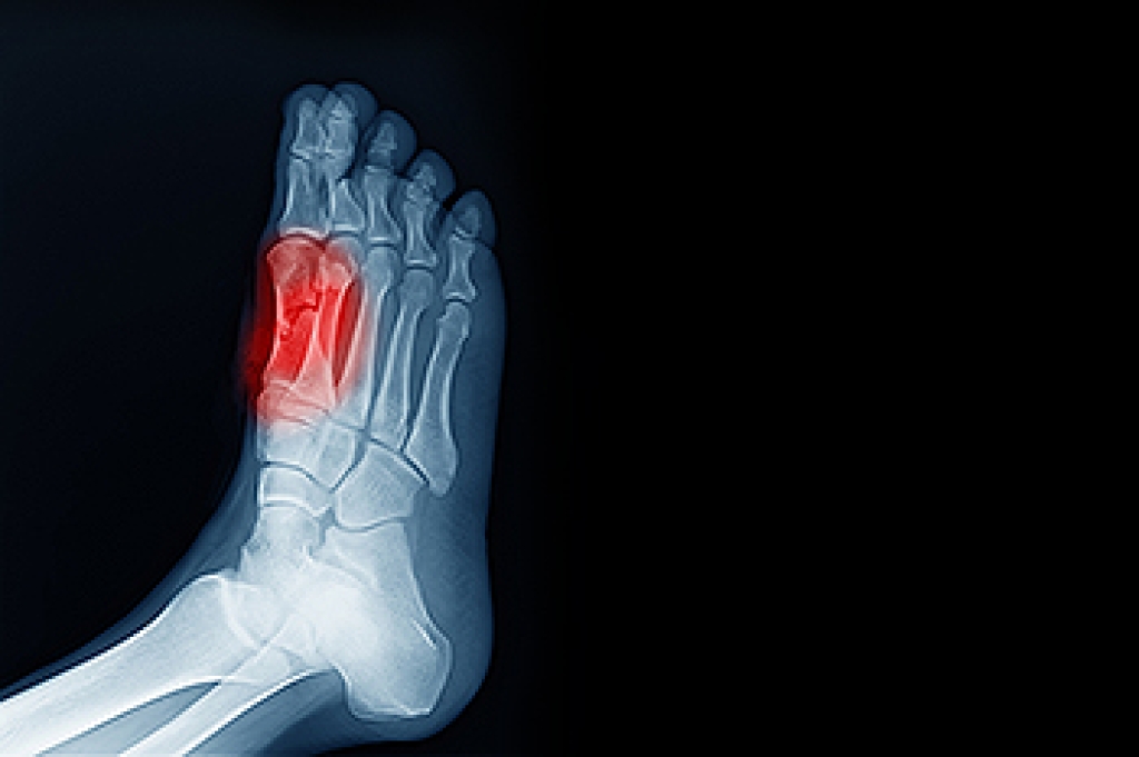 Pain Under the Big Toe Can Signal Sesamoiditis