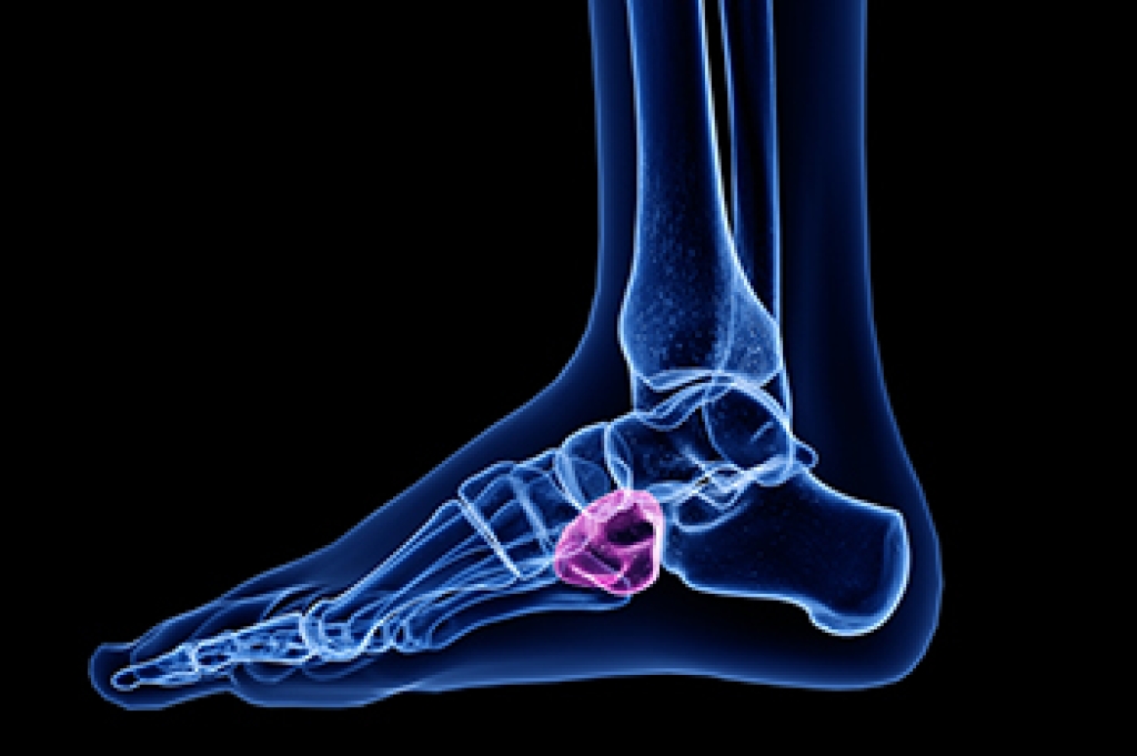 Cuboid Syndrome and Midfoot Pain