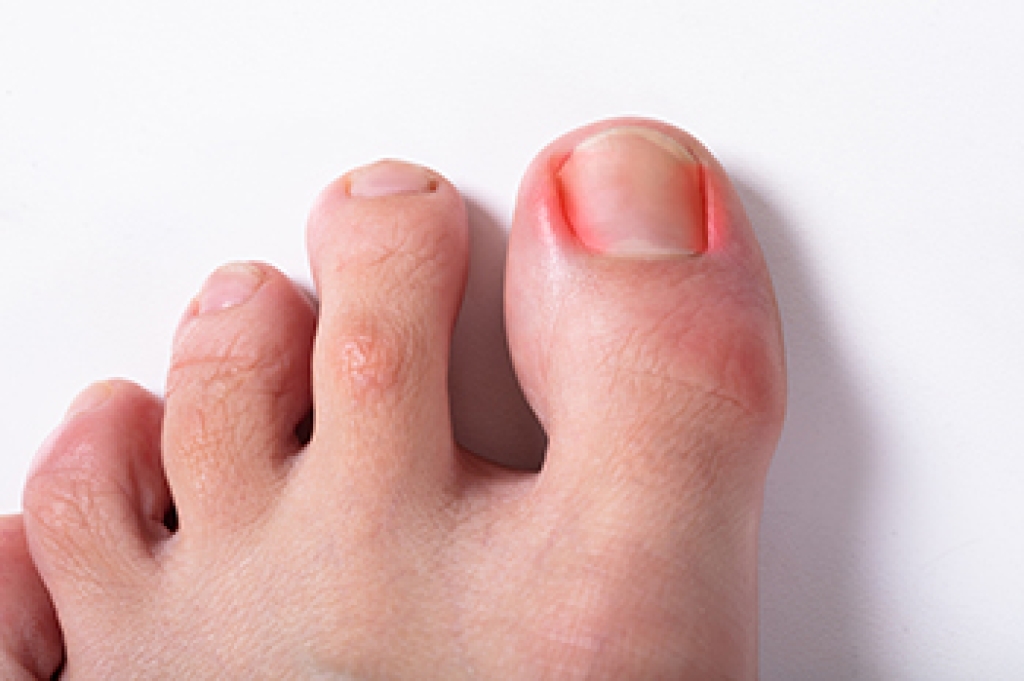 Ingrown Toenails in Athletes