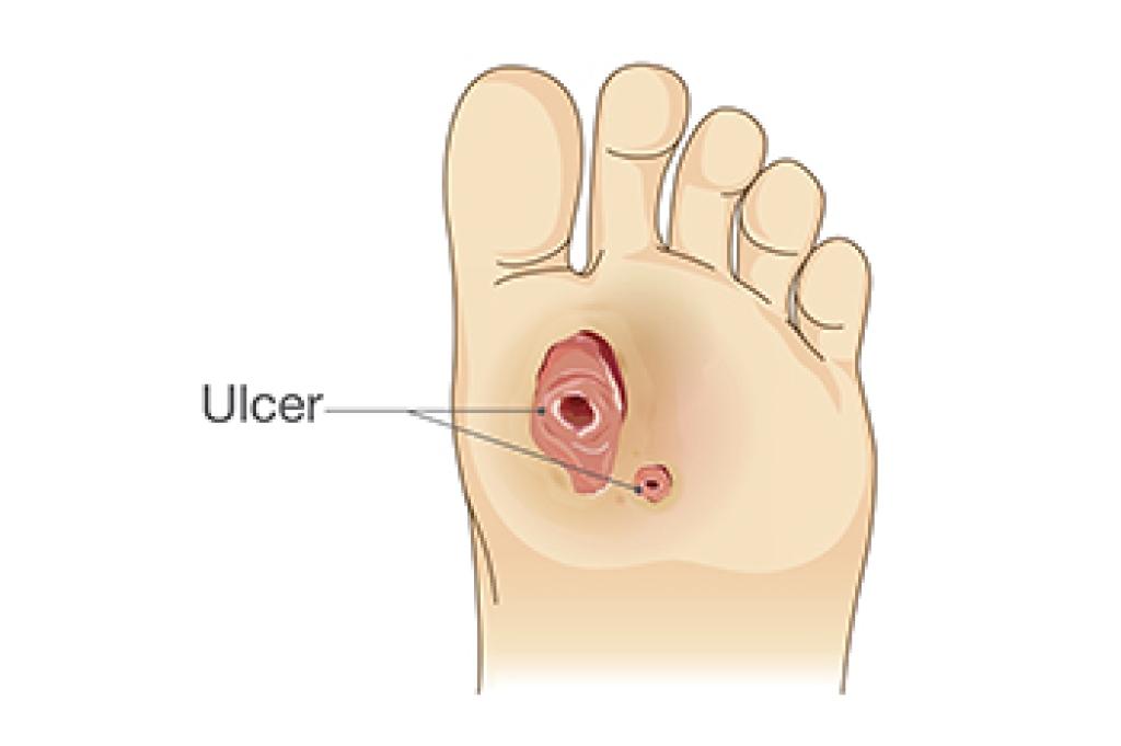 When a Diabetic Foot Wound Becomes Dangerous