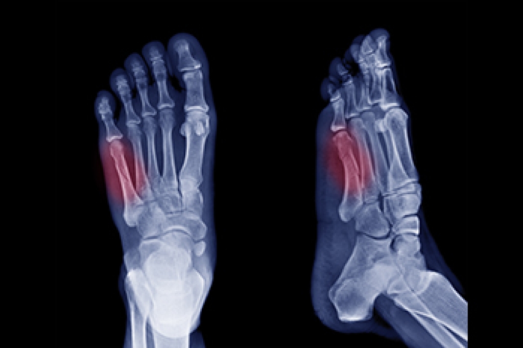Facts About 5th Metatarsal Fractures