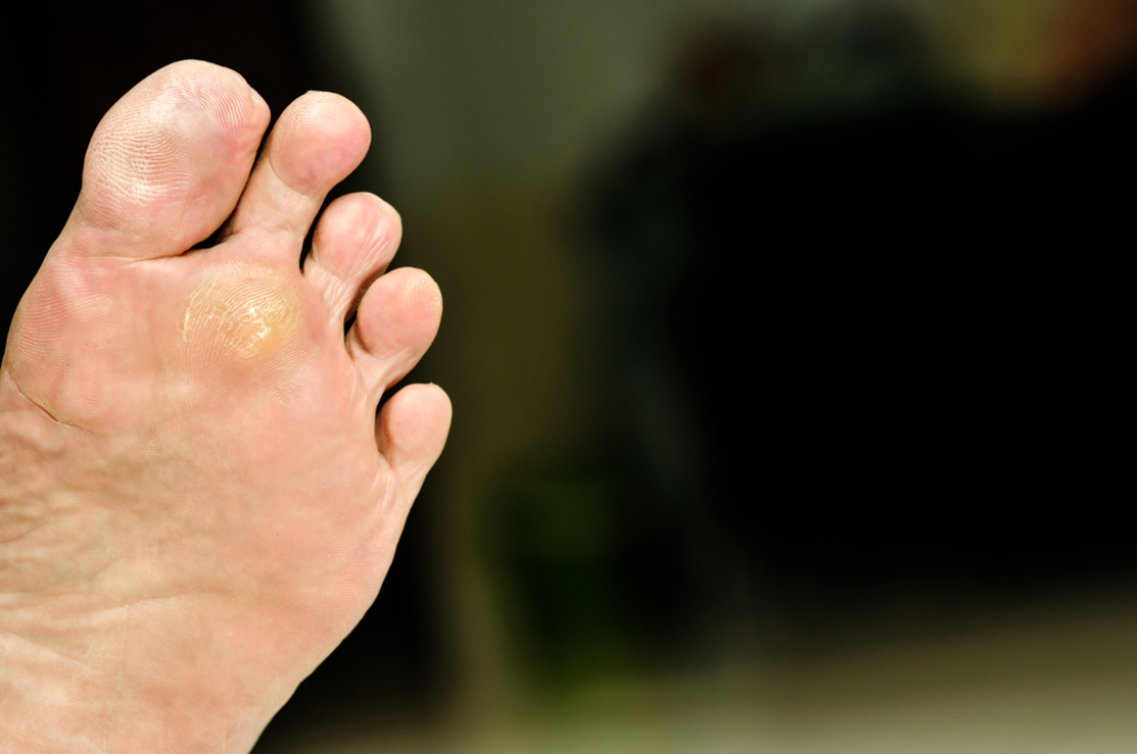When Plantar Warts Become a Problem