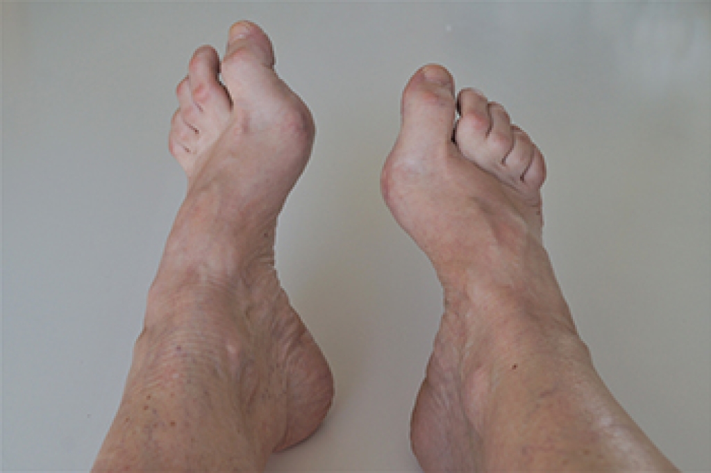 Types and Causes of Foot Deformities