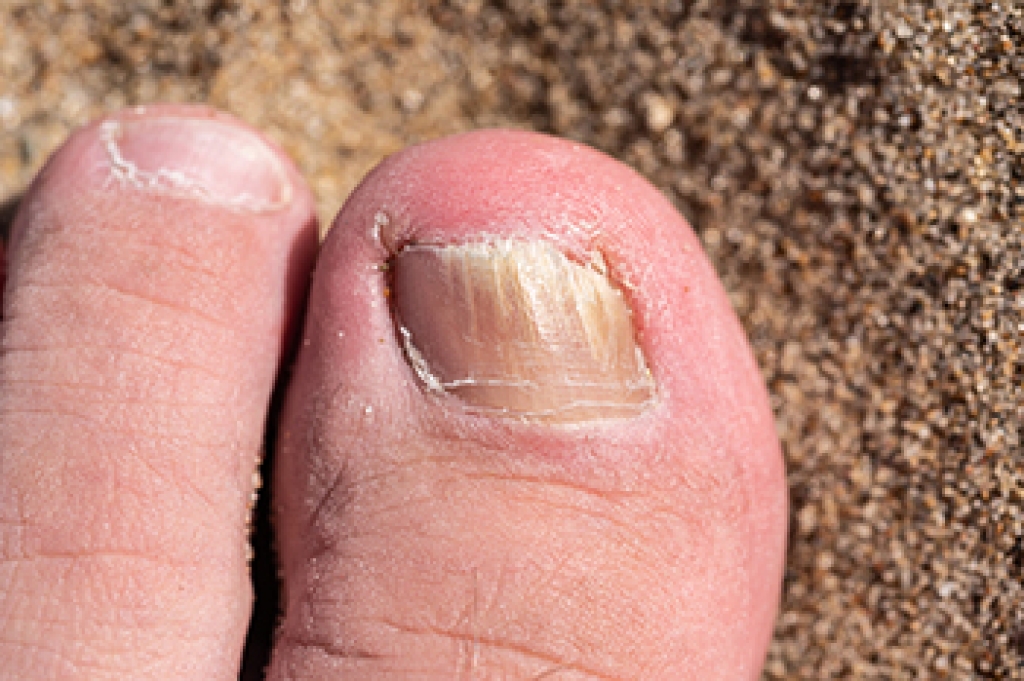 Symptoms and Causes of Fungal Toenails