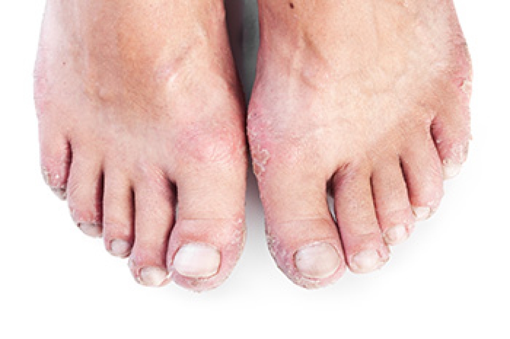 How Psoriatic Arthritis Affects the Feet