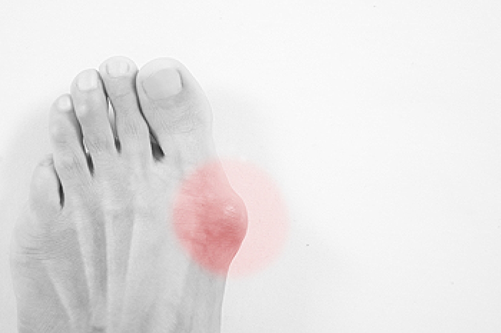 What are Bunions?