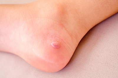 Understanding Friction Blisters on the Feet