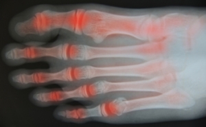 Causes and Symptoms of Psoriatic Arthritis in the Feet