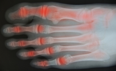 Causes and Symptoms of Psoriatic Arthritis in the Feet