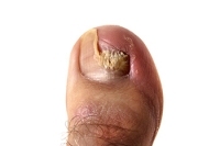 Facts About Toenail Fungus